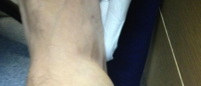 Chris Mears Ankle